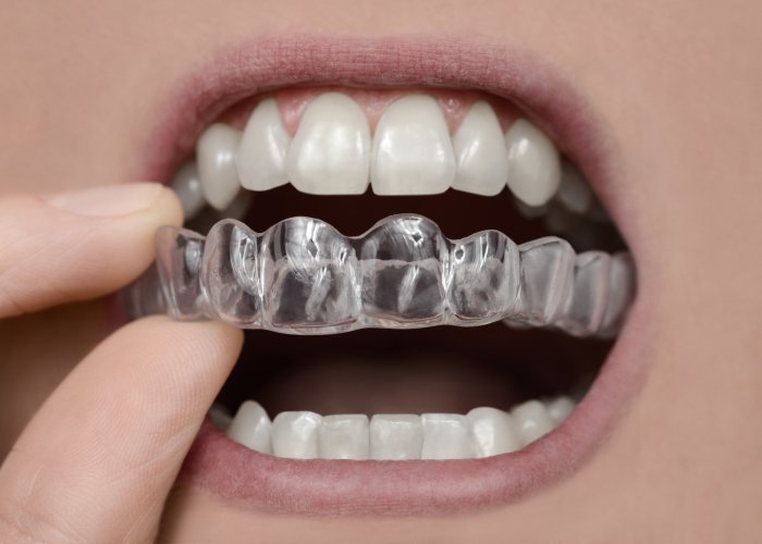 Retainer retainers orthodontic appareil dentaire ortodonzia orthodontiste straighten odontoiatria tradizionale emilia